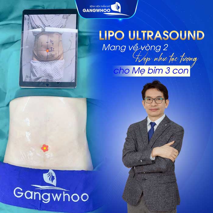 Lipo Ultrasound công nghệ hút mỡ hiện đại chỉ sau 60p bạn có có được vòng 2 như mong muốn