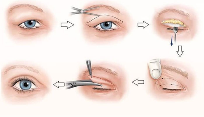 Phương pháp cắt mí mắt bị sụp hiệu quả