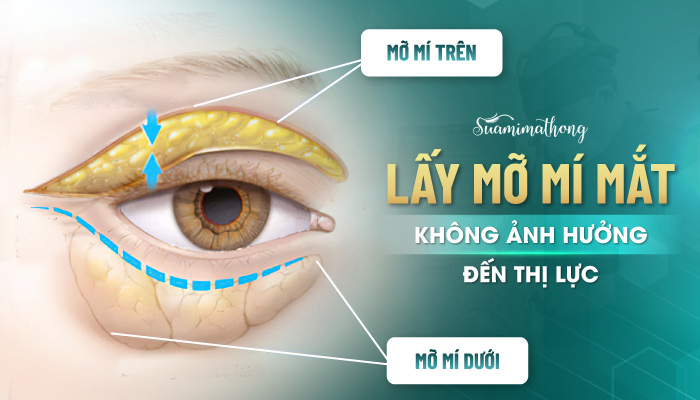 Cắt mỡ mí mắt có ảnh hưởng đến thị lực không?